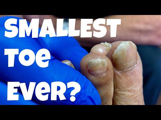 THE SMALLEST TOE IN THE WORLD 