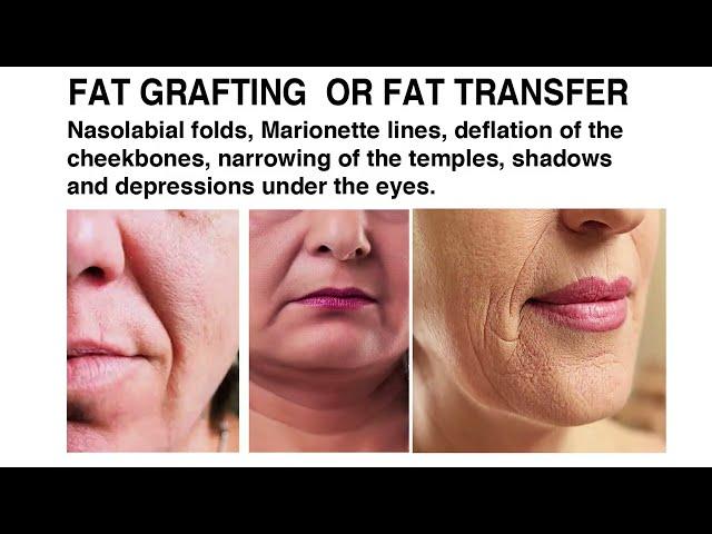 Results of Fat Grafting Ludhiana, Punjab | Kyra Aesthetic Clinic Dr Vikas Gawri