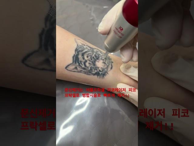 #문신제거#울산문신제거#울산피부과#울산남구피부과#부산문신제거#경주문신제거#문신제거피코#피코레이저#피코프락셀#울산피코