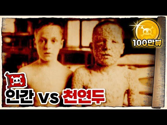  역사상 가장 많은 사람을 죽인... 두창바이러스 /  천연두는 얼마나 무서웠을까?