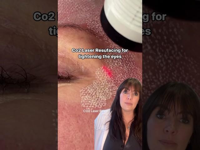Co2 Laser for tightening the eyes non-surgically  #skincarecommunity #co2 #co2laser #eyelift