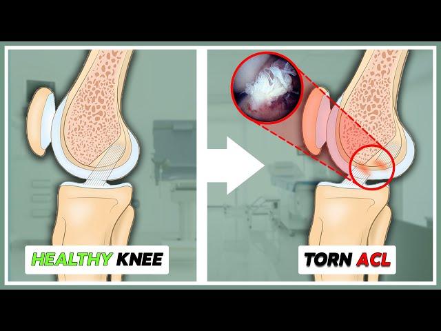 Torn ACL? Surgery vs. Conservative Treatment: What You Need to Know