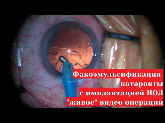 Факоэмульсификация катаракты с имплантацией ИОЛ - живое видео операции замены хрусталика глаза
