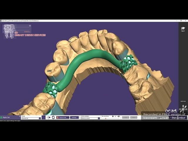 Upper Partial Denture #designing