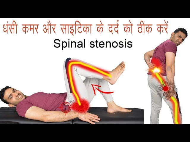 Treat Sciatica Nerve Pain - कमर दर्द ,पैरों में दर्द जाना, झनझनाहट, सुन्नपन, जलन ठीक करें