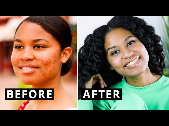 How I Healed My Acne with a Whole Food Plant-Based Diet (STEP BY STEP)