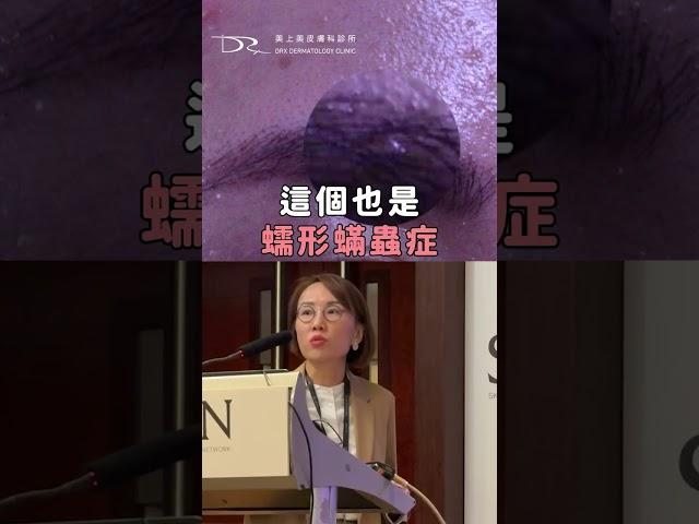 蠕形蟎蟲肌之一症狀教你看 #內包粉刺 #閉鎖性粉刺 #角質栓 #痘痘肌 #舒利達 #蠕形蟎蟲 #膚質改善 #痘痘 #青春痘 #粉刺