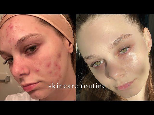 the skincare routine that FINALLY cleared my acne