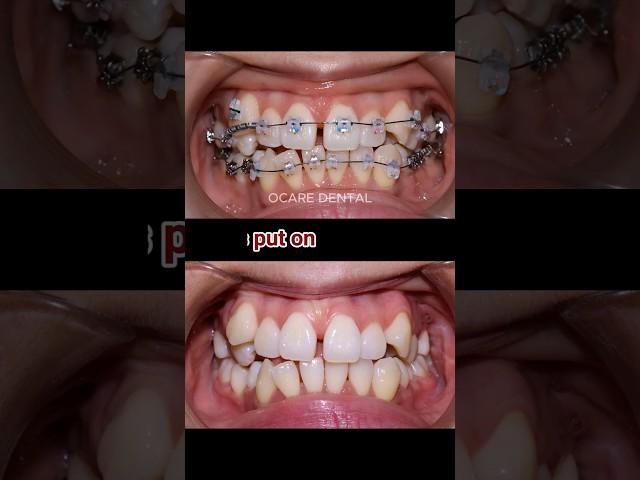 Braces animation 32 months #braces #orthodontist #dentist #dental #dentistry
