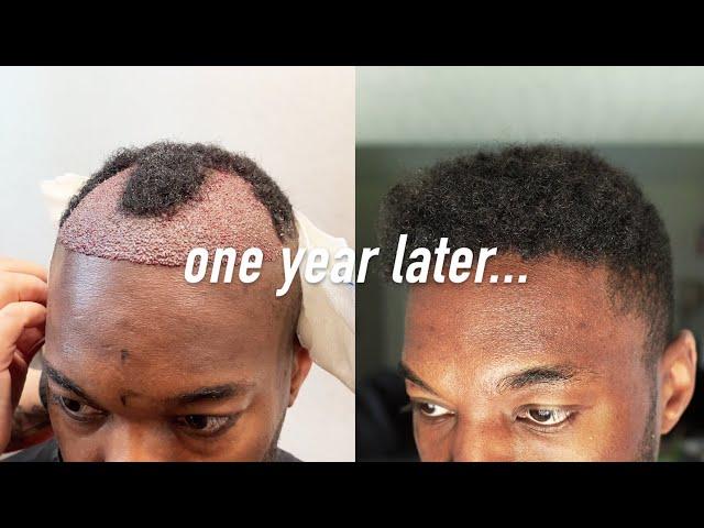 1 Year Istanbul, Turkey FUE Hair Transplant Results | I AM RIO P.