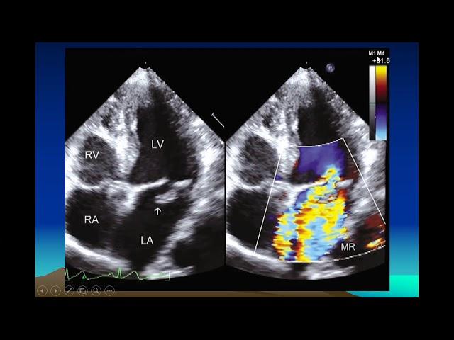 Valvular Regurgitation By  Dr Navin  C Nanda