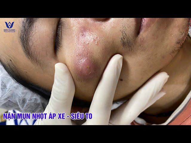 Nặn mụn nhọt áp xe gò má - Cam kết hết mụn, không để lại sẹo.