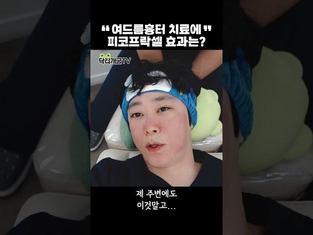 여드름 흉터치료. 피코프락셀 효과는 어떨까?