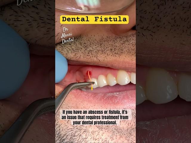 DENTAL FISTULA, PARULIS