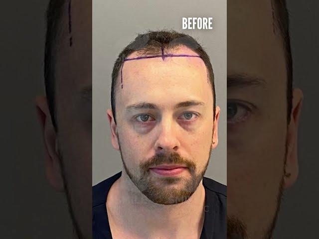 Hair Transplant Before and After of Matthew! 6 MONTHS / 5000 Grafts