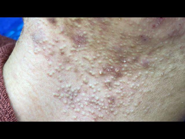 Acne Treatment For "Hung" (P11) | Điều Trị Mụn Cho Hùng (P11) - SacDepSpa#207