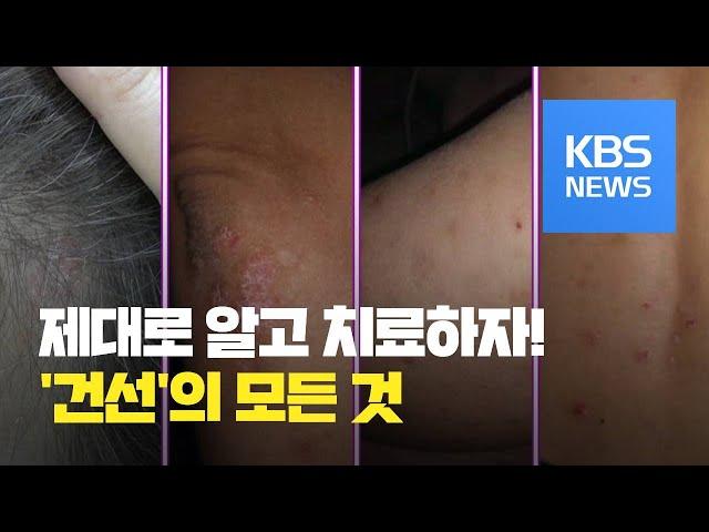 [똑! 기자 꿀! 정보] 혹시 당신도 ‘건선’? 제대로 알고 치료하자! / KBS뉴스(News)