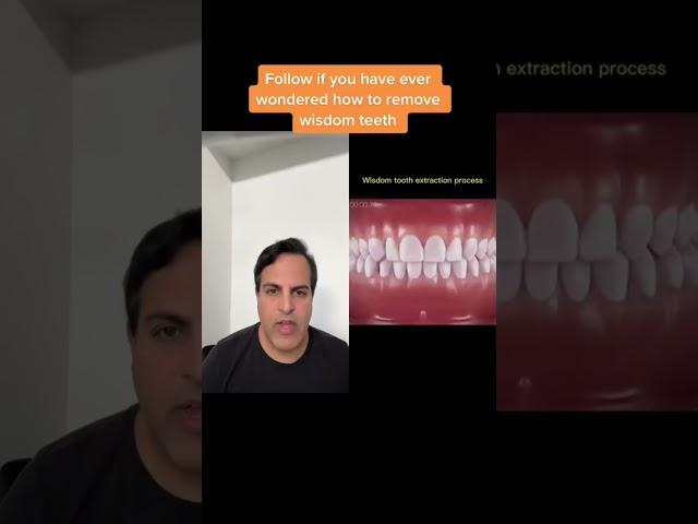 Wisdom tooth removal animation#wisdomtooth#tooth, #teeth #Surgery