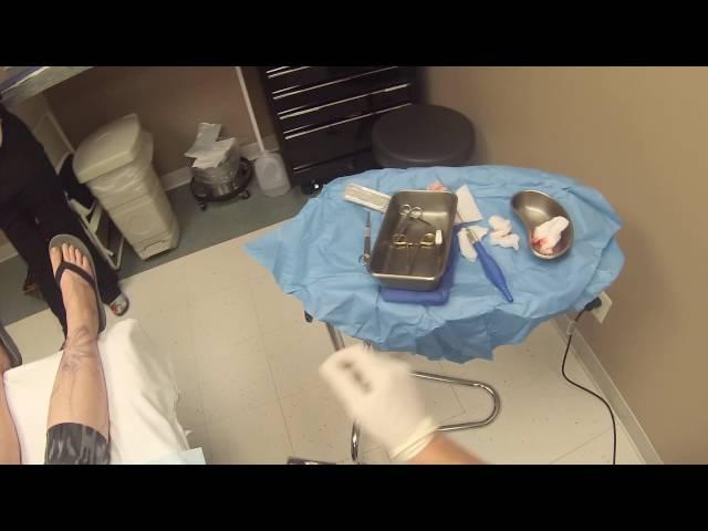 Smart Lipo on the Neck - The GoPro Cosmetic Surgeon