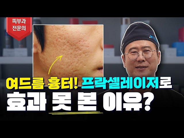 여드름흉터 프락셀레이저로 효과가 없는 이유!? (feat 프락셀 레이저, 서브시전) #여드름흉터프락셀 #여드름없애는방법