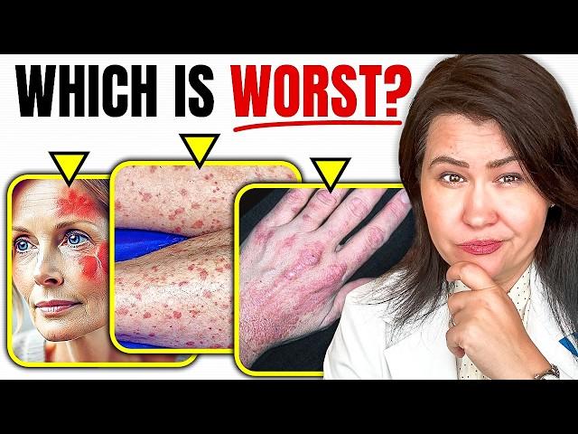 The 3 WORST Autoimmune Diseases!