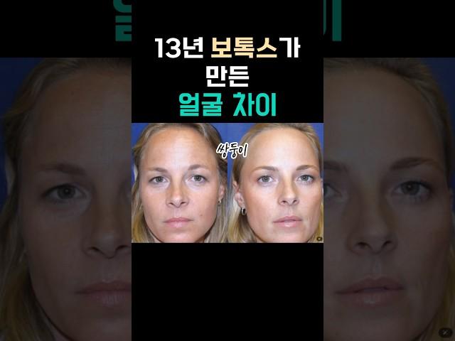 13년 보톡스 실험, 쌍둥이얼굴 이렇게 바뀜