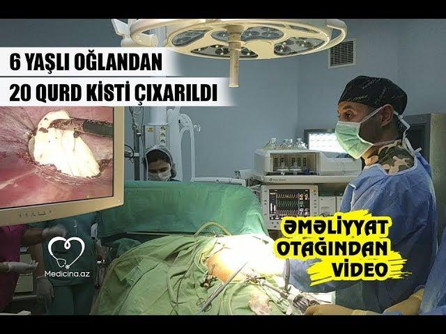 Medicina.az: Azərbaycanda 6 yaşlı oğlandan 20 qurd kisti çıxarıldı