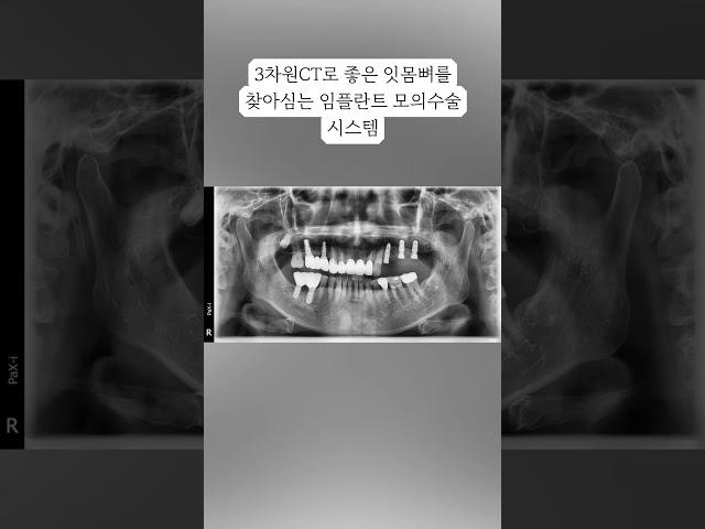 좋은 잇몸뼈를 찾아심는 컴퓨터분석 임플란트(02 886 2877신도림역 가이치과) #임플란트 #임플란트치과 #임플란트비용 #치과 #구로구 #신도림 #금천구 #양천구 #shorts