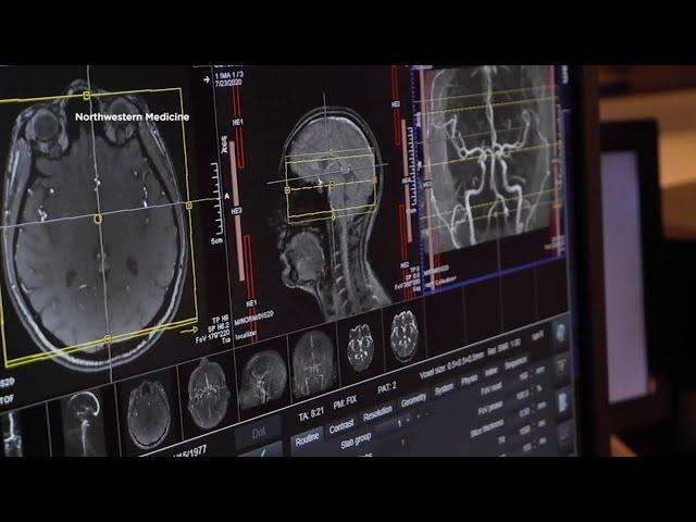 New study from SF Gladstone Institutes sheds light on cause of brain fog due to COVID-19