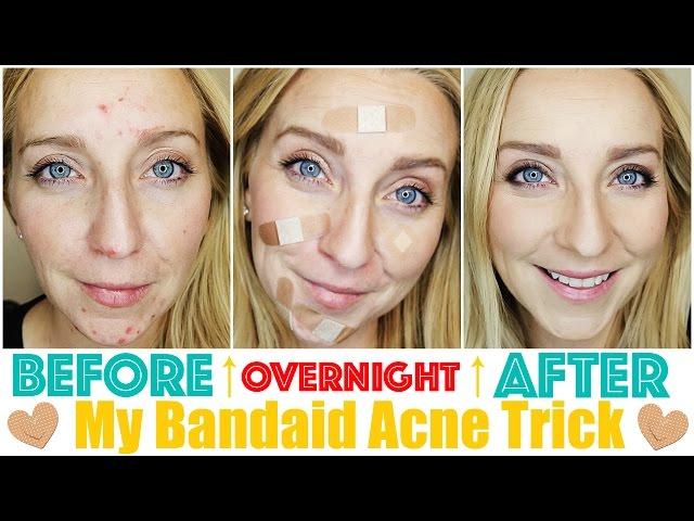 How to Get Rid of Acne Fast & OVERNIGHT with My Bandaid Trick!