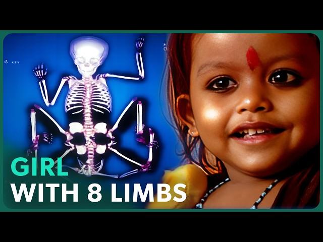 The Girl Born With 8 Limbs: Hindu Goddess Or Normal Little Girl?