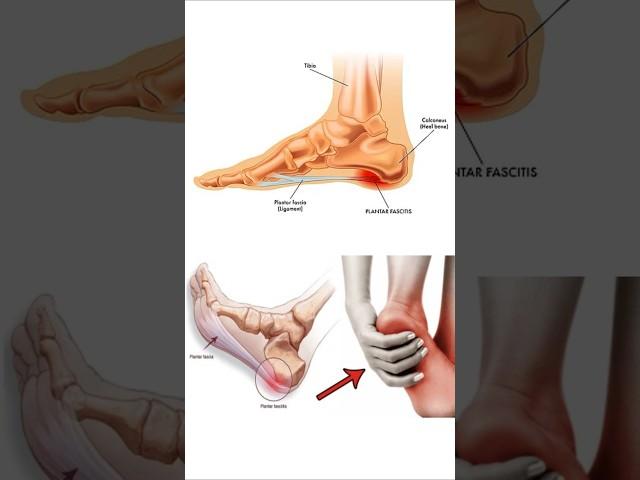 Heel Pain Relief EXERCISE at HOME | Simple Exercise For Plantar Fasciitis | #heelpain #exercise