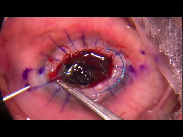 AIOS2025-VT254-Dr.Karan BHATIA-Triple Procedures - Challenges During Lens Management