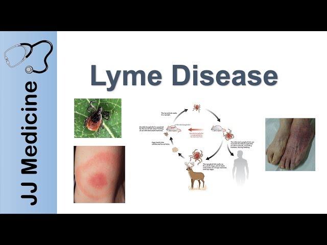 Lyme Disease | Pathophysiology, Signs, and Treatment