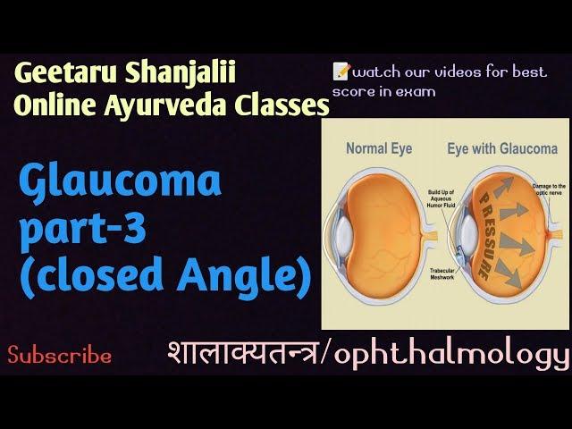 Closed angle glaucoma By geetaru Shanjalii BAMS AYURVEDA shalakyatantra ophthalmology Gitaru ayurved