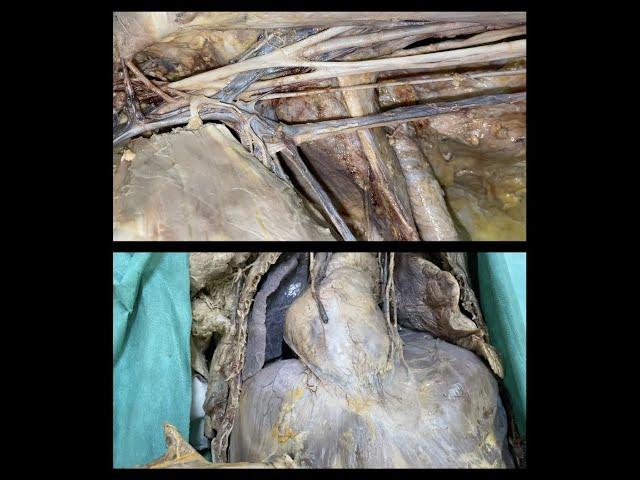 Anatomy of upper limb and thorax (dissection)