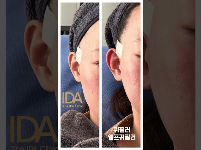 요즘 가장 핫한 필러가 어떤 필러인지 아시나요?