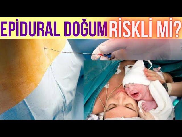 EPİDURAL DOĞUM ( Prenses Doğum ) Avantaj ve Riskleri Nelerdir ? ZARARI Var mı?