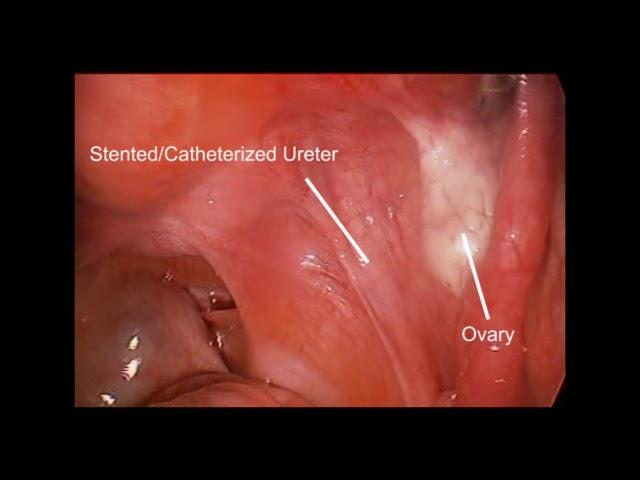 Catheterized Ureter FINAL