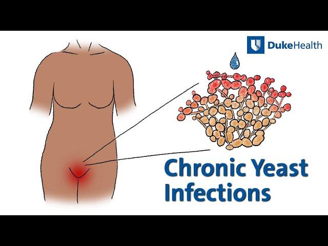 Chronic Yeast Infections – Causes and Treatment | Duke Health