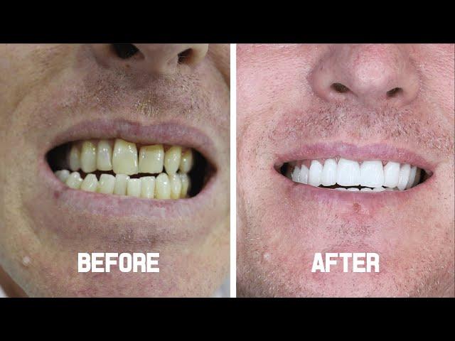 Cosmetic Dentistry (Zirconium Crowns) - Leon from The UK