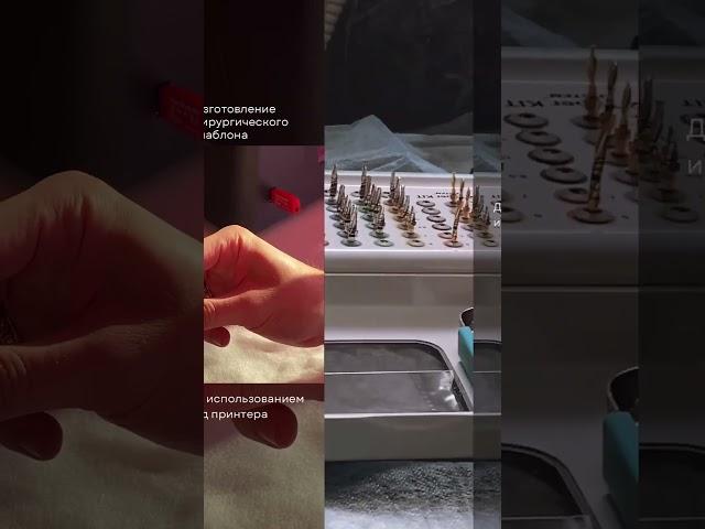 Цифровая имплантация в стоматологии Блеск