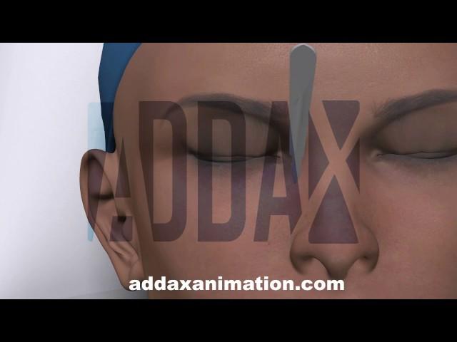 blepharoplasty animation