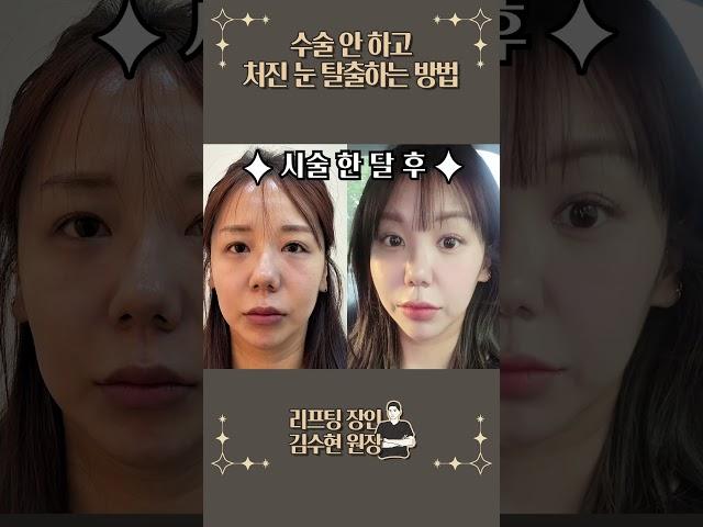 내 눈에 신세계가 열리는 법..! #이마실리프팅 #lifting #실리프팅잘하는곳 #실리프팅전후 #오브의원 #김수현원장