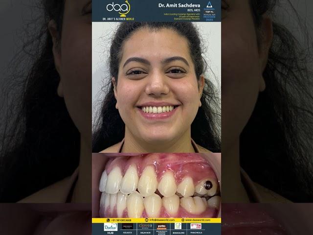 Client Tesitimonial | Dr Amit Sachdeva India's most experienced Invisalign Braces Specialist.