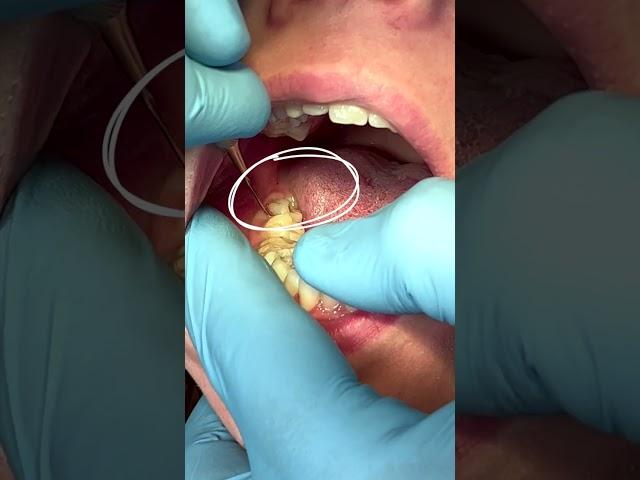 Extraction of the 8th tooth or "wisdom" tooth