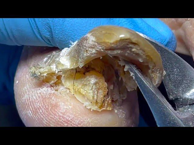 Super long nails haven’t been cut in half a year! Pull out thick onychomycosis【Pedicure Lin Jun】