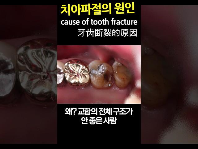 cause of tooth fracture