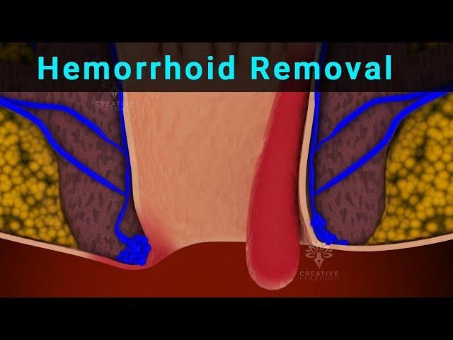 Hemorrhoid Removal Surgery Explained | Hemorrhoidectomy | PilesTreatment - creativeleaning3d