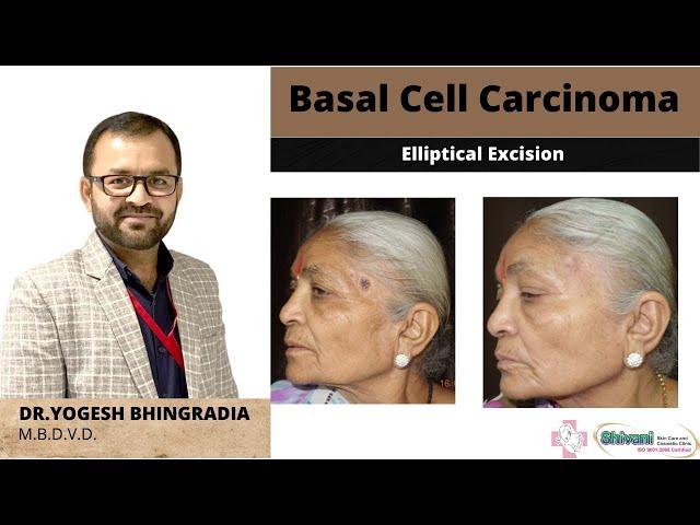 BASAL CELL CARCINOMA | ELLIPTICAL EXCISION | DR YOGESH BHINGRADIA
